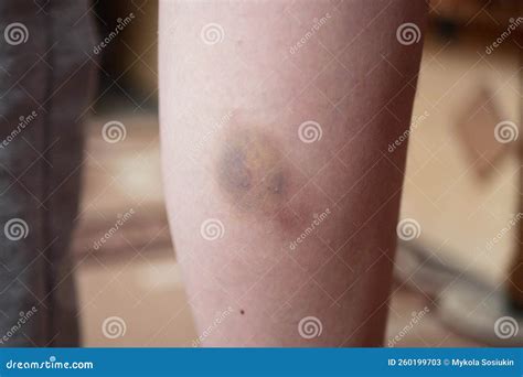Hematoma On The Skin Of The Legs Stock Image 185195281