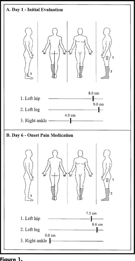 Figure 1 From Treatment Of Neuropathic Pain In A Patient With Diabetic