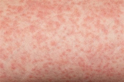 Scarlet Fever Stock Image C0234294 Science Photo Library