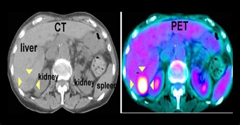Pet CT Scan SRMS IMS Bareilly