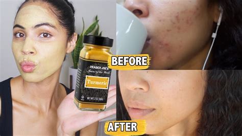 Proof That Turmeric For Acne Works And How To Use It Youtube