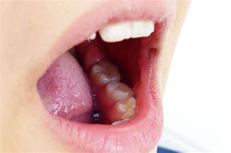 What Are Tonsil Stones Facty Health