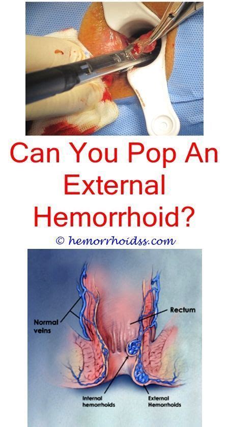 The most common and effective surgical option for thrombosed hemorrhoids is the external hemorrhoidectomy. Thrombosed Hemorrhoid Removal Video - maternity photos