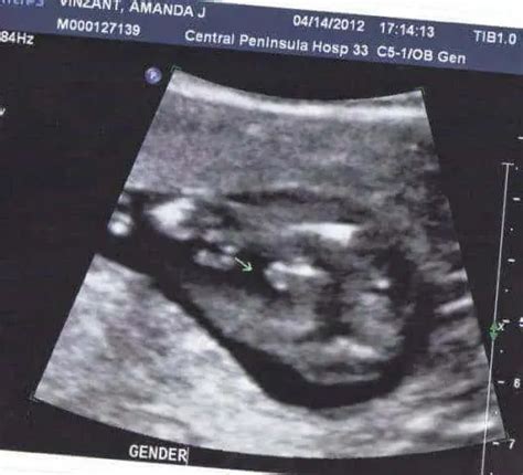 Boy Or Girl Ultrasound Wrong Gender Scan Accuracy
