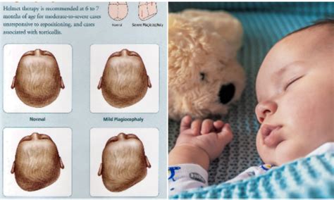 Punca Bayi Alami Sindrom Flat Head And Ini 6 Bantal Yang Sesuai Untuk Mereka