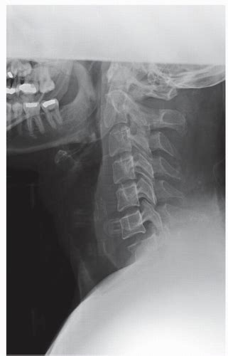 Cervical Spine Plain Radiography Neupsy Key