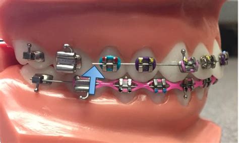 Poking Or Broken Wire Tustin Ca Legacy Orthodontics