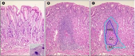 Predictive factors of response and outcome// am j gastroenterol 2002; mucosa-associated lymphoid tissue(MALT) lymphoma : 네이버 블로그