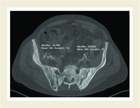 Computed Tomography Parameters In The Posterior Iliac Crest Download
