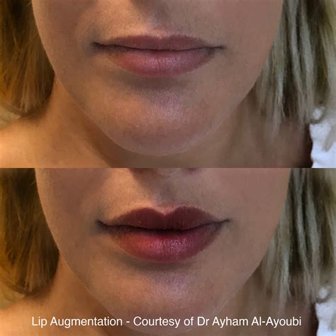 Lip Enhancement Lip Fillers Harley Street London Best Advice And Reviews