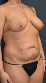 Nashua Abdominoplasty Before And After Photos Manchester Plastic