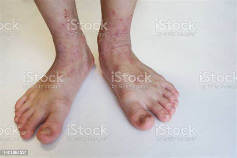 Male Shin With Redness And Itchy Rash On Skin Stock Photo Download