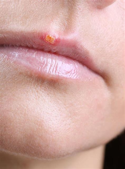 How Do I Tell The Difference Between A Cold Sore And A Pimple