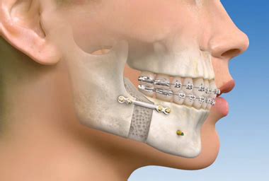 The return statement in this case is used to exit the function early. RiteBite Orthodontics: What is Orthognathic Surgery?