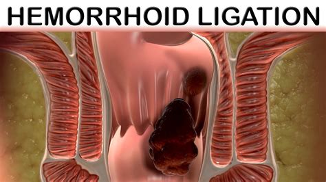 Rubber Band Hemorrhoid Ligation Trinsic Medical Animation Youtube