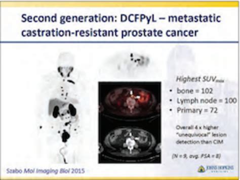 Breakthrough In Prostate Cancer Imaging Johns Hopkins Medicine