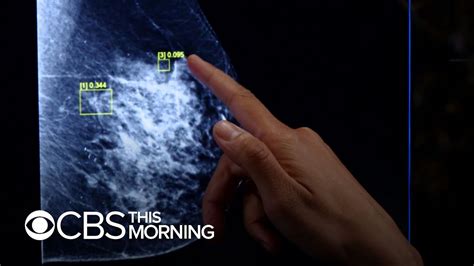 Artificial Intelligence Aims To Improve Breast Cancer Diagnoses Youtube