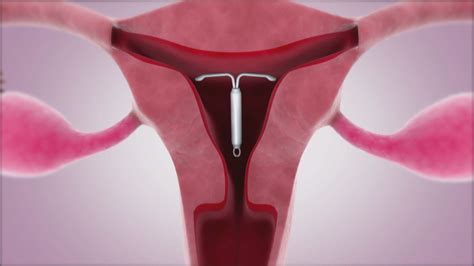 Iud Most Effective Birth Control Method Canadian Pediatricians Declare