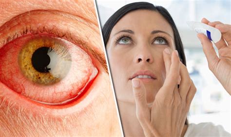 Expert Warns Red And Bloodshot Eyes Could Be A Warning Sign Of Eye