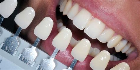 Dental Fillings In Kingston Ontario Gardiners Dental Clinic