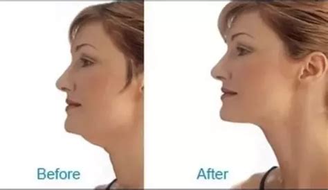 For others, it is taking. How could one slim the face and sharpen the jawline by ...