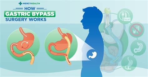 Is gastric bypass surgery covered by insurance? How Gastric Bypass Surgery Works | Mercy Health