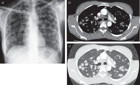 Indeed, a differential diagnosis during this time may include malignancy, tuberculosis, sarcoidosis, and other pulmonary infections or fungal diseases such as histoplasmosis. Pulmonary tuberculosis masquerading as metastatic lung ...