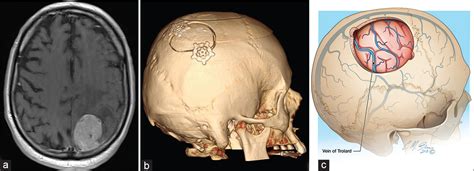 Posterior Fossa Craniotomy