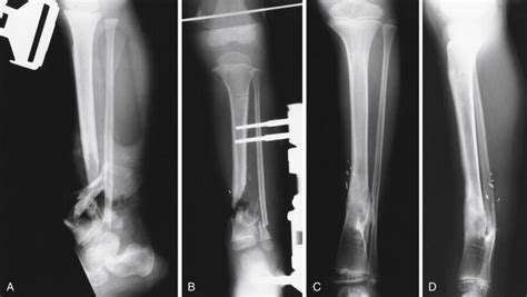 Fractures Of The Tibia And Fibula Musculoskeletal Key