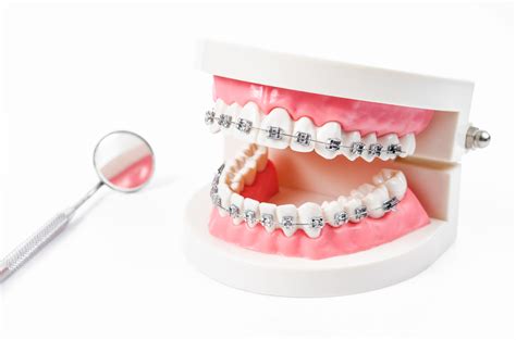 Insurance companies often classify dental procedures into one of four categories: Does Insurance Cover Braces ~ news word