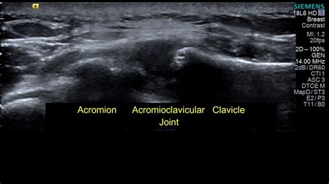 Ultrasound Guided Intraarticular Acromioclavicular Joint Injection