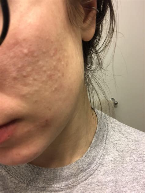 Help With Pus Filled Bumps On Cheek Racne