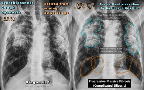 Progressive Massive Fibrosis Aka Complicated Silicosis Silicosis