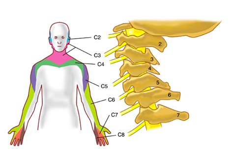 Cervical Radiculopathy Hand And Arm Pain