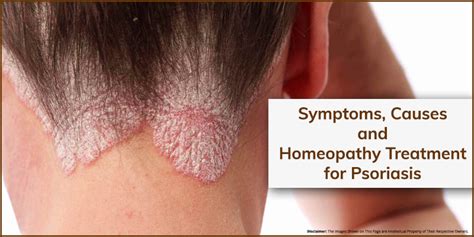 Symptoms Causes And Homeopathy Treatment For Psoriasis