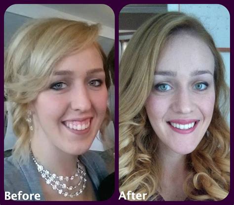 Jaw Surgery Before And After Pictures Jaw Surgery Pictures Diet