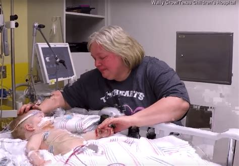 Praise God Twins Conjoined At The Torso Successfully Separated After 7