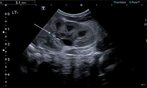 Renal Ultrasound Imaging In A Preterm Infant With A Persistently