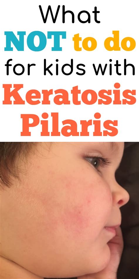 Keratosis Pilaris Treatment What Not To Do For Kp Skin