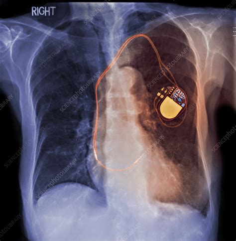 Implantable Defibrillator Pacemaker Stock Image C0047524