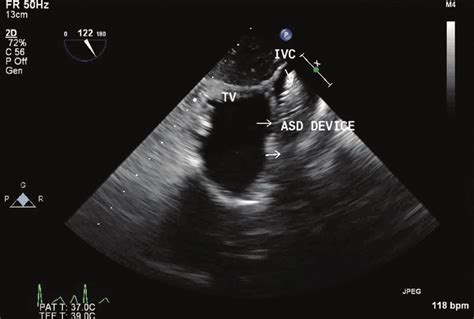 Transesophageal Echocardiography Transgastric Right Ventricle