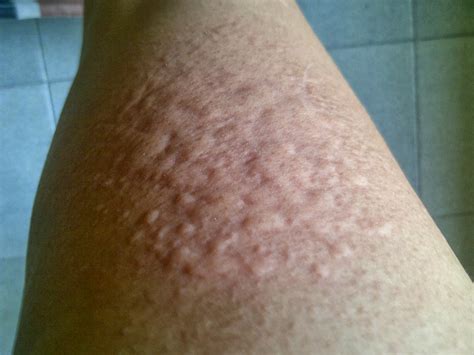 Ini 8 cara menghilangkan gatal pada kulit. cara menghilangkan gatal karena alergi kulit ~ RUMAH ...