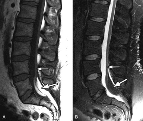 Tethered Spinal Cord Radiology Key