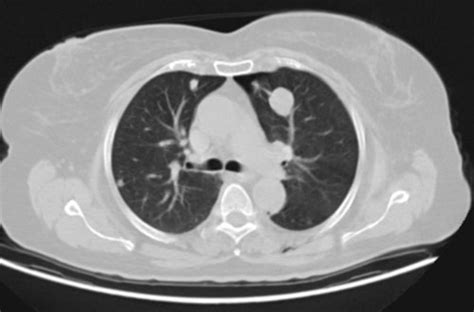 An Uncommon Cause Of Multiple Pulmonary Nodules Pulmonary Hyalinizing