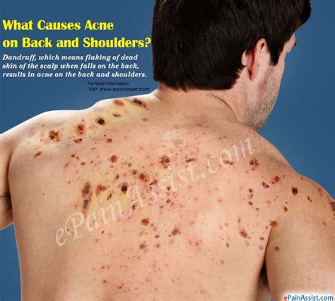 What Causes Acne On Back And Shoulders And How To Get Rid Of It