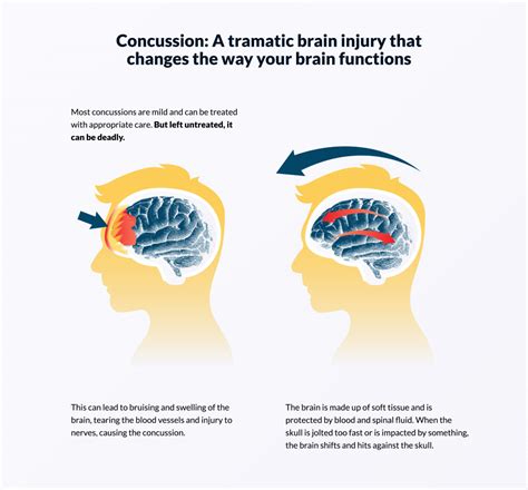 Brain Injury Statistics