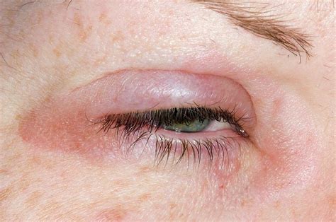 Eyelid Swelling Due To Allergy Photograph By Dr P Marazziscience