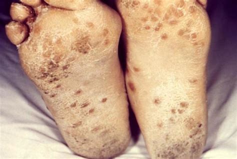 Foot Rash Causes Symptoms Treatment 2023 Vrogue Co