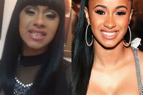 Cardi B Before And After Plastic Surgery Botox Facelift Body