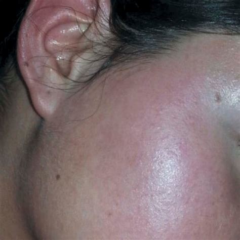 Increasing In Skin Temperature Erythema And Mild Swelling In Two